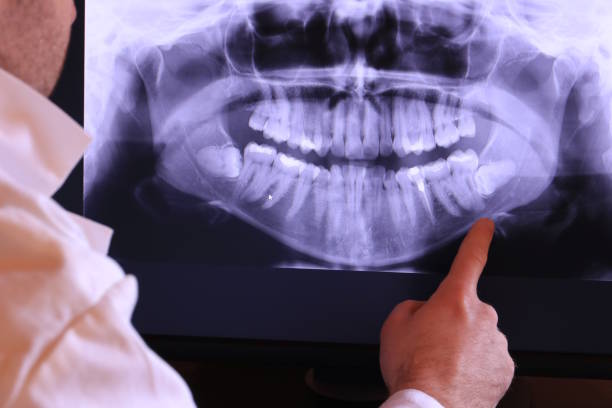 Best Emergency Wisdom Tooth Extraction in Lawson Heights, PA