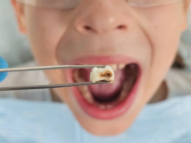 Best Knocked-Out Tooth (Avulsed Tooth) Treatment in Lawson Heights, PA